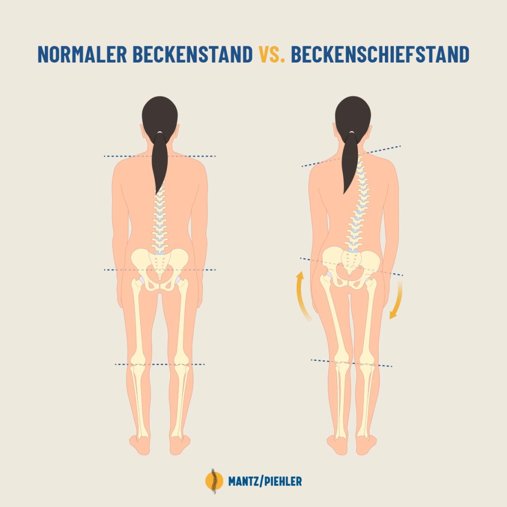 Beckenschiefstand