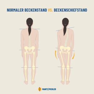 Beckenschiefstand