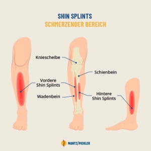 Shin Splints Behandlung